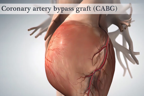 Heart Bypass Surgery Videos