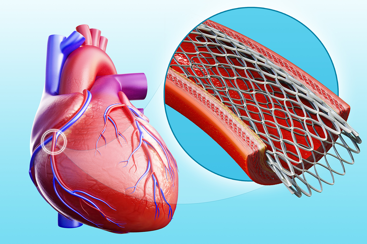 Heart-Stent-Procedure