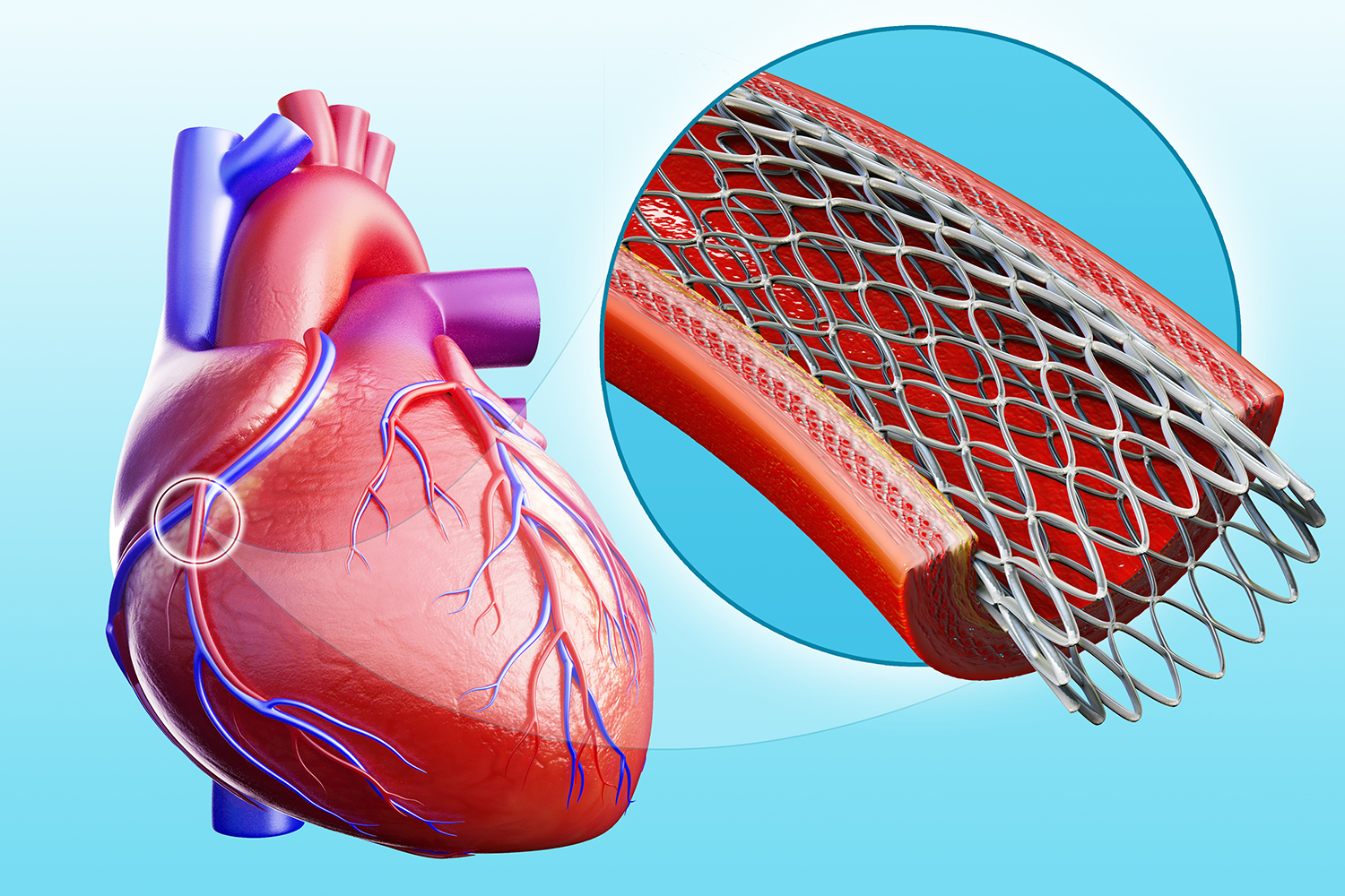 stent in the heart