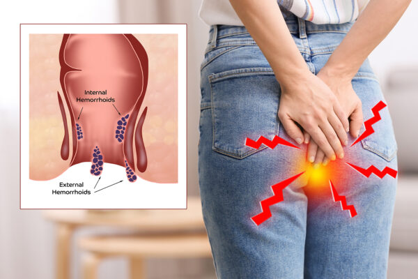 Hemorrhoids Surgery Videos