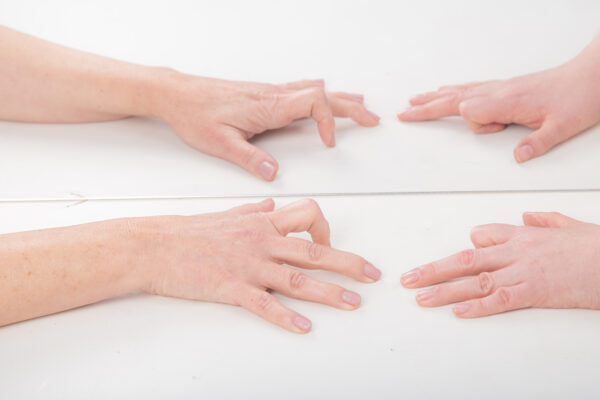 Complex Regional Pain Syndrome