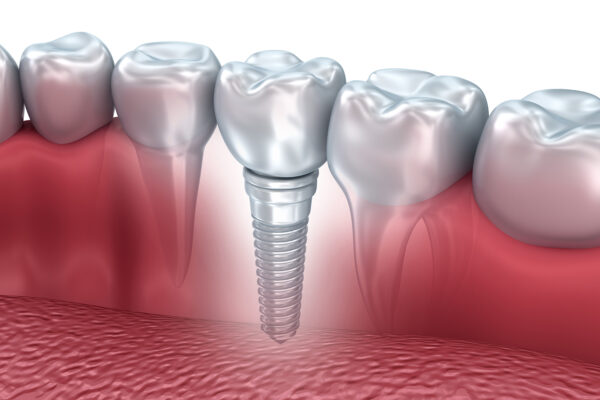 Dental Implant