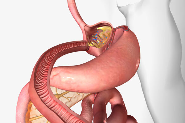 Gastric Bypass Surgery