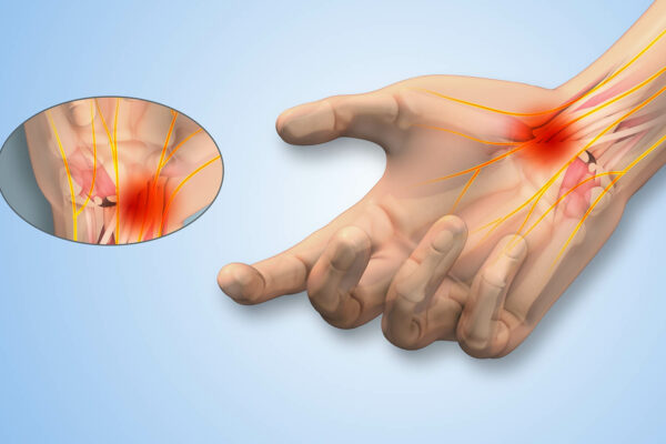 Carpal Tunnel Syndrome Surgery