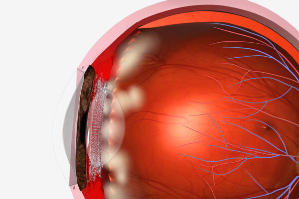 Corneal Transplant