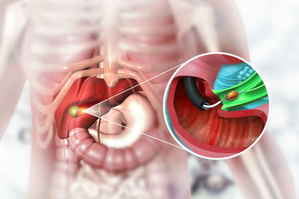Gallbladder Removal Surgery