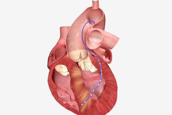 Heart Ablation Surgery