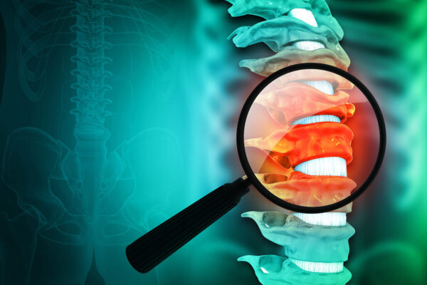 Spondylosis Definition