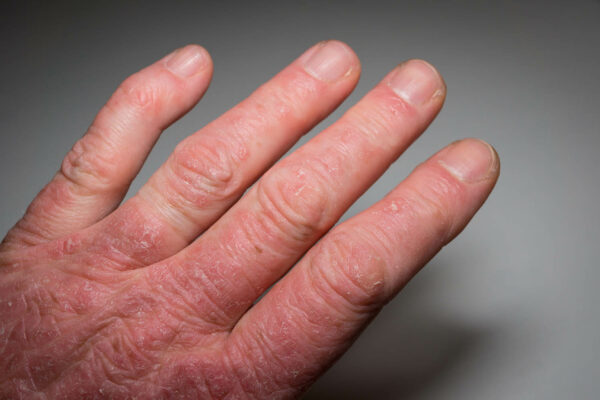 Symptoms Of Psoriatic Arthritis