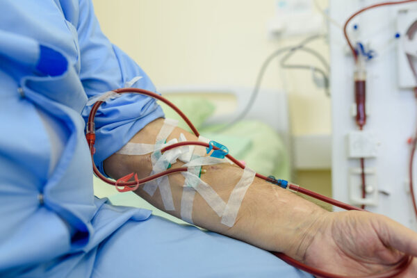 Av Fistula