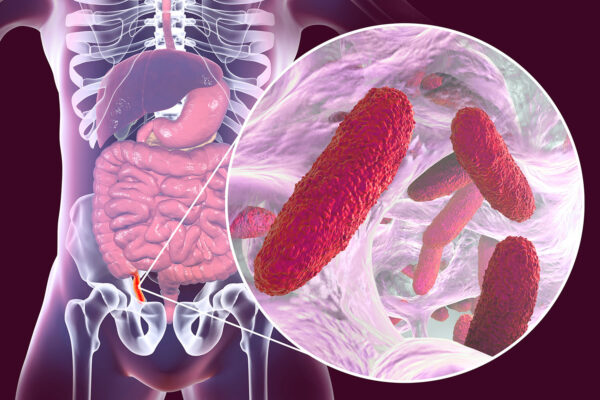 Appendectomy Cause