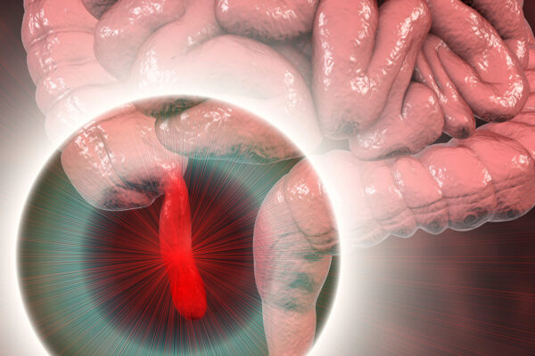Appendicitis