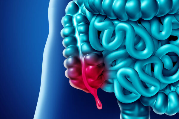 Appendicitis Surgery