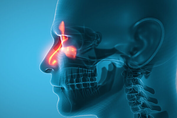 Balloon Sinuplasty