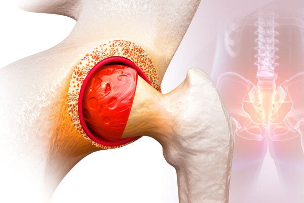 Bursitis In Hip