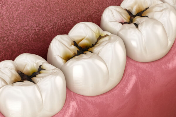 Caries