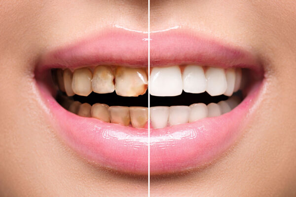 Dental Caries