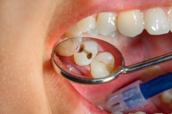 Dental Caries Cavities
