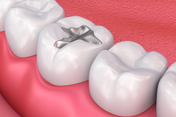 Dental Fillings