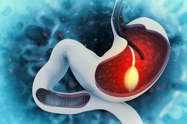 Gastric Balloon