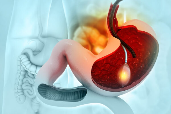 Gastric Bypass