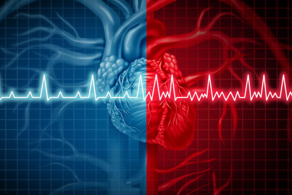 Heart Ablation
