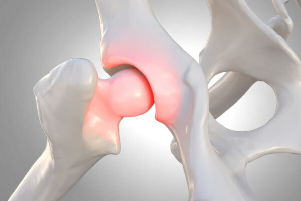 Hip Labral Tear