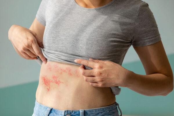 Hives On Skin