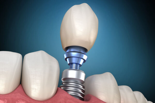 Implants Dental