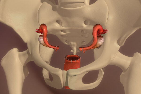 Laparoscopic Hysterectomy
