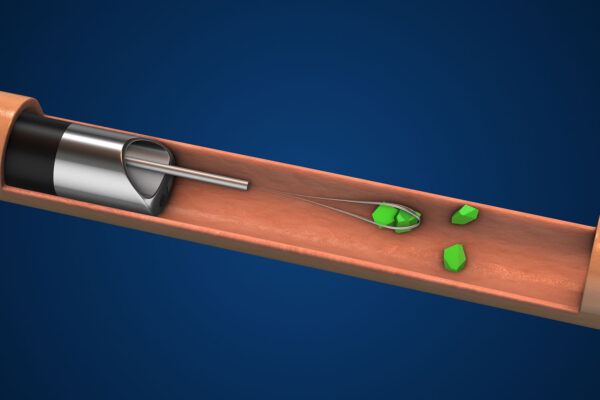 Lithotripsy