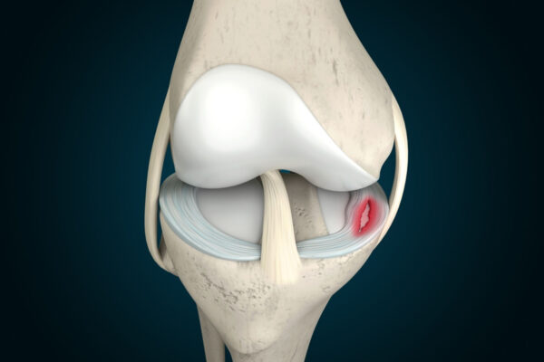 Meniscal Tear