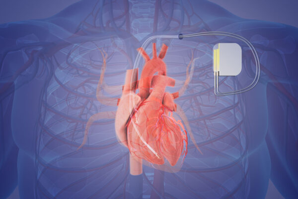 Pacemaker Surgery