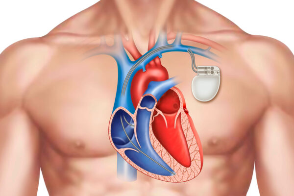 Pacemaker Of The Heart