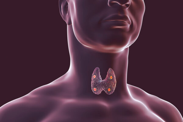 Parathyroidectomy