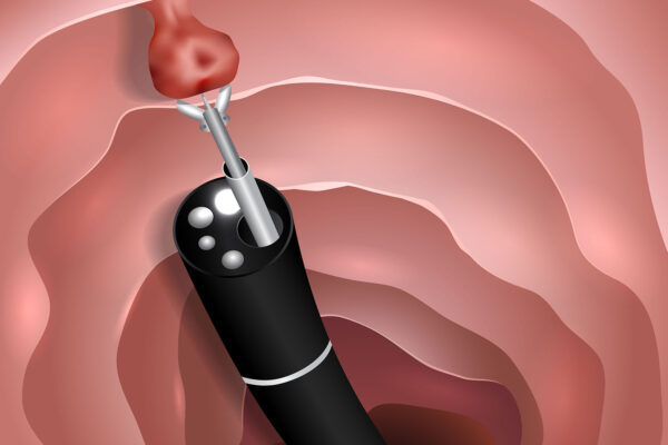 Polypectomy