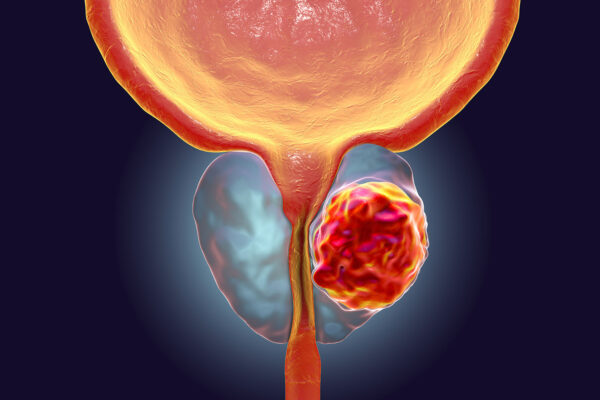 Prostate Biopsy