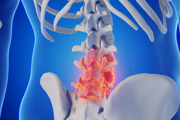 Rhizotomy