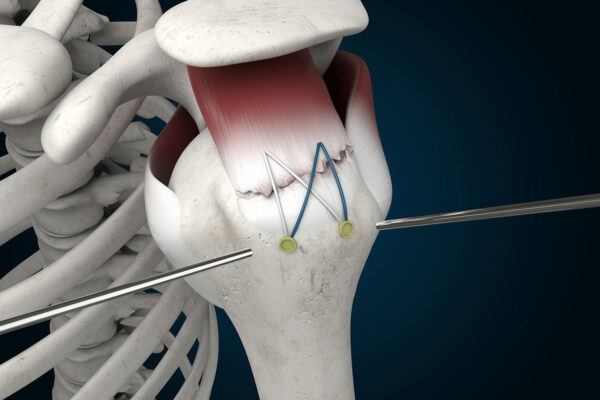 Rotator Cuff Surgery