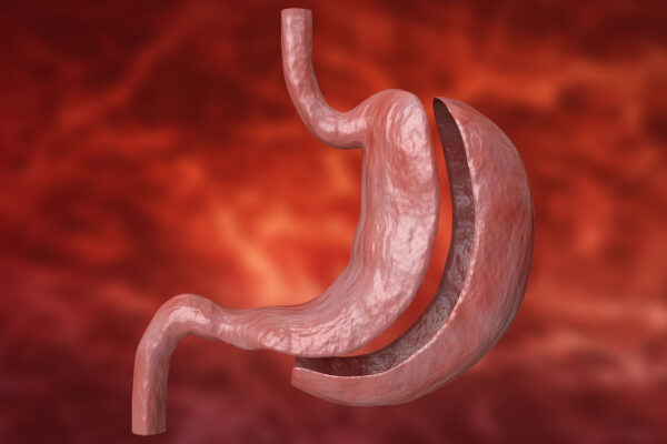 Sleeve Gastrectomy