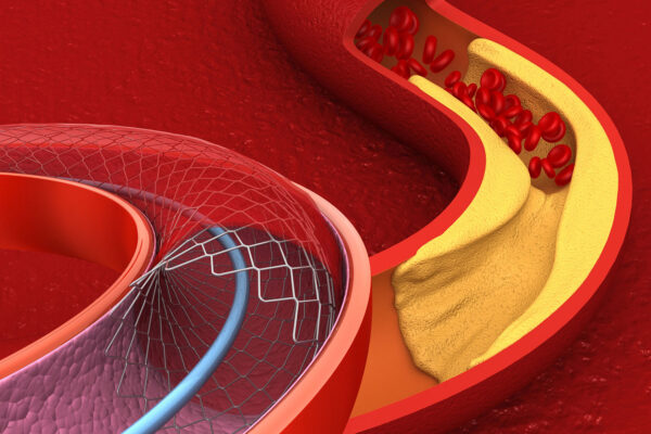 Stent Placement