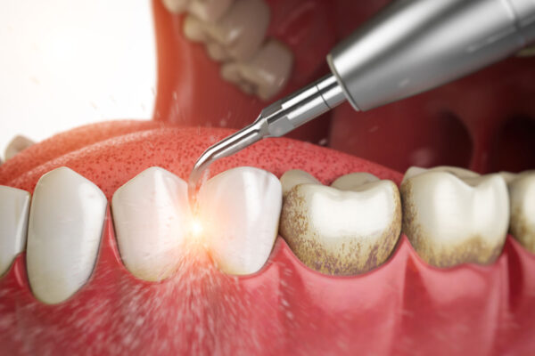 Teeth Cleaning