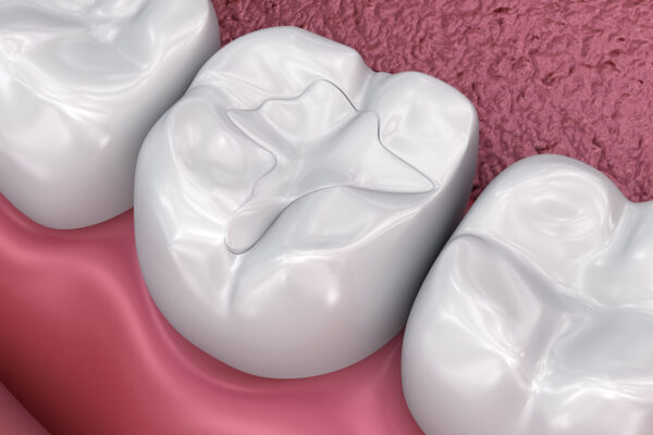Teeth Filling