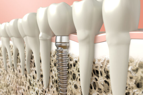 Teeth Implants