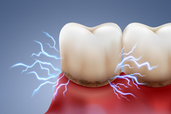 Tooth Decay Treatment
