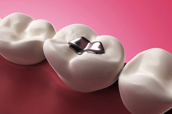 Tooth Filling