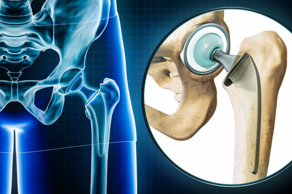 Total Hip Replacement