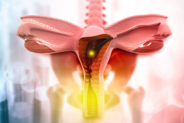 Total Hysterectomy