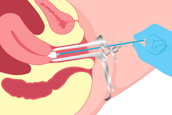 What Is A Pap Smear
