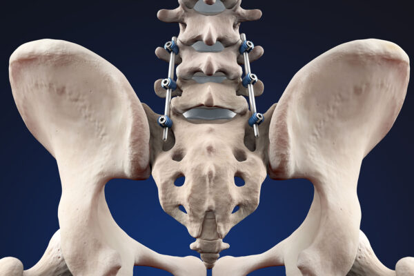 Arthrodesis